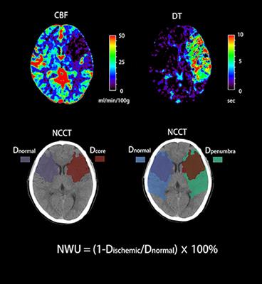 Net water uptake, a neuroimaging marker of early brain edema, as a predictor of symptomatic intracranial hemorrhage after acute ischemic stroke